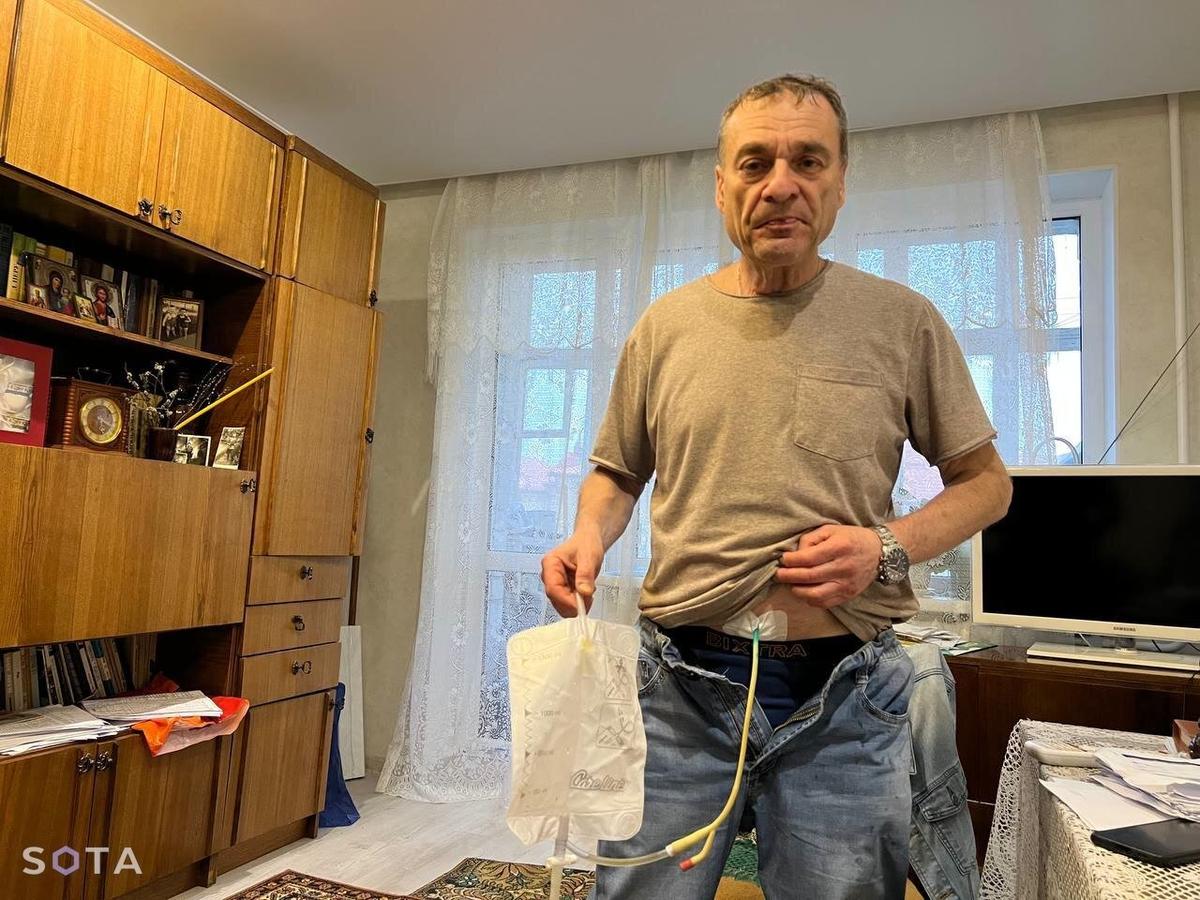 Игорь Барышников с установленной в животе специальной трубкой с мочеприёмником. Фото: SOTA